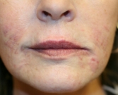 Feel Beautiful - Lip Lines and wrinkles around lips - After Photo